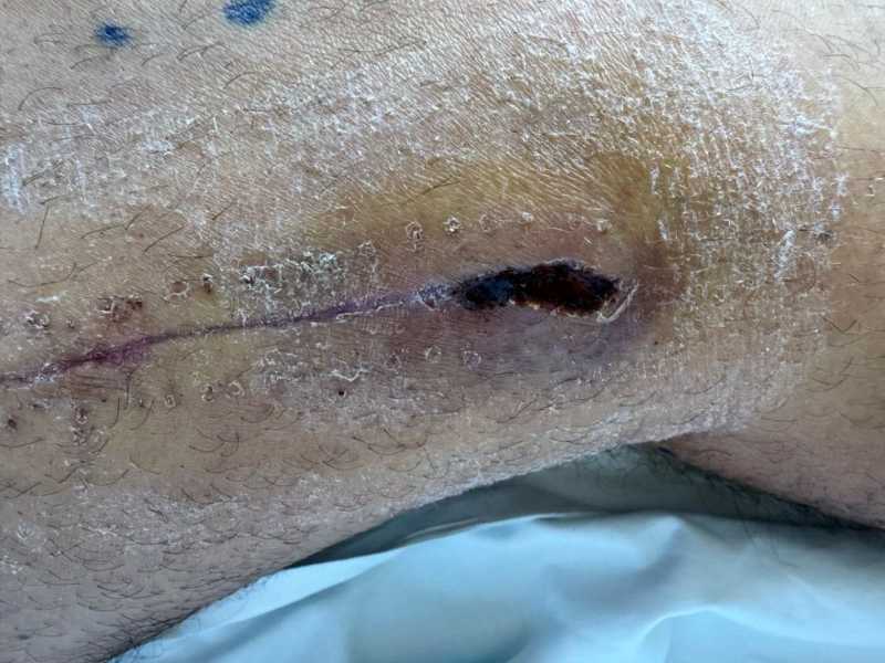 Alberto Durán, en aislamiento por dos bacterias contagiosas